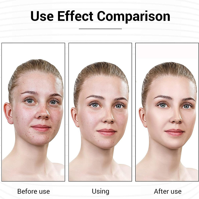 Facial chitosan wound dressing. Hydrating and moisturizing mask to prevent skin aging (5 pieces/box)