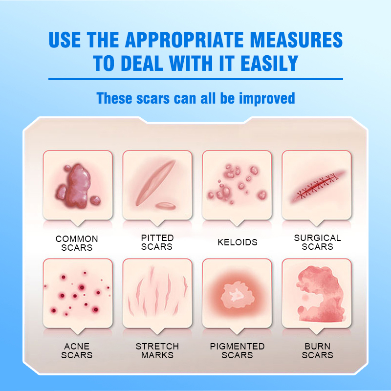 This medical-grade scar repair cream can repair acne scars, atrophic scars, stretch marks, pigmentation scars, surgical scars, burn scars, and more. Suitable for all skin types!