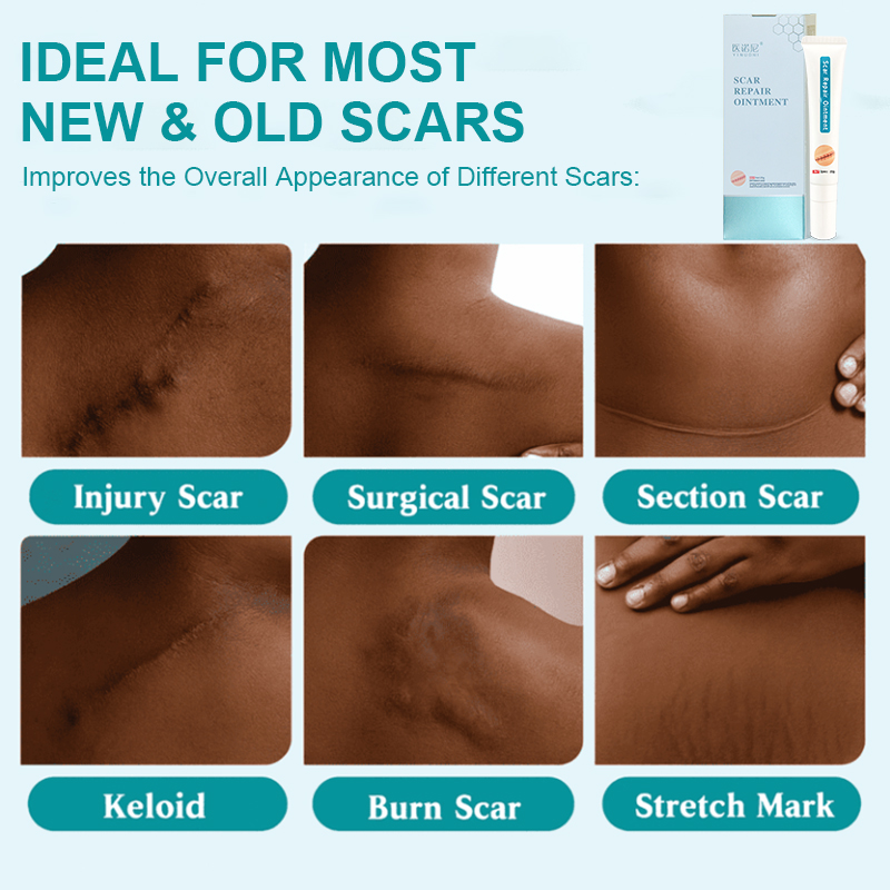 This medical-grade scar repair cream can repair acne scars, atrophic scars, stretch marks, pigmentation scars, surgical scars, burn scars, and more. Suitable for all skin types!